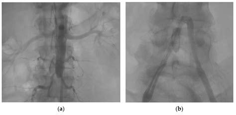 Chronic Complete Distal Aortic Occlusion and Pulmonary Embolism ...