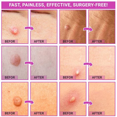 Buy Skin Tag Removal Kit, Small & Standard Skin Tag Remover Device, 36 ...