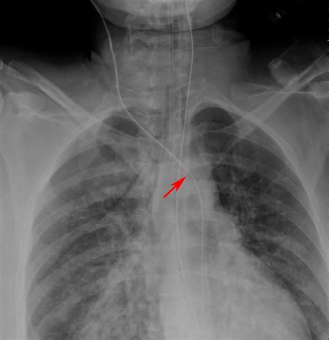 Left Internal Jugular Vein Catheter X Ray at Suzanne Crotts blog