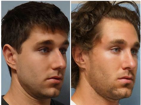 Facial Plastic Surgery: Male rhinoplasty, Cosmetic rhinoplasty, Nose job, Crooked nose, Nasal ...