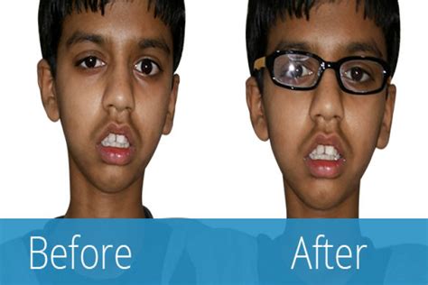 Buy special Ptosis eye crutch glasses in India- Artificial Eye Co