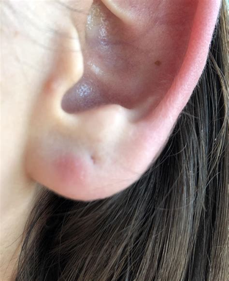 These weird red bumps on my hands don't hurt, but flair up at random ...