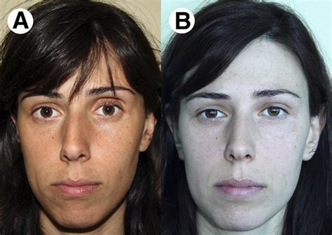 Bilateral Silent Sinus Syndrome: Case Report and Surgical Solution - Journal of Oral and ...