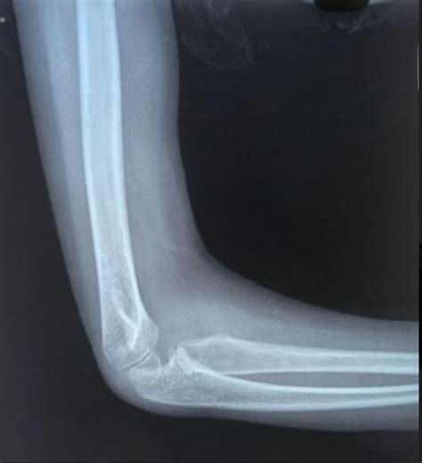 Congenital radial head dislocation in a six year old child treated ...
