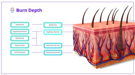 Burn Depth - Classification, Assessment, Characteristics.