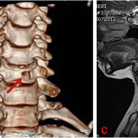 Postoperative CT showing that the disc-osteophyte complex had been ...