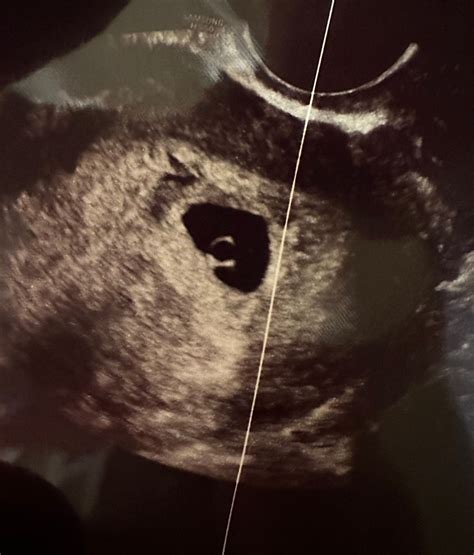 6 Week Ultrasound | BabyCenter