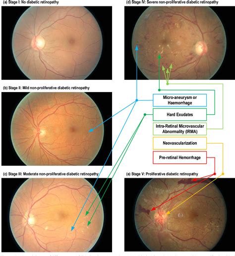 Diabetic Retinopathy Stage Classification Using Convolutional Neural ...