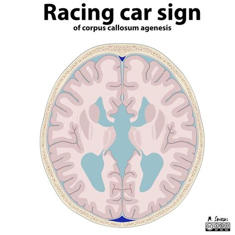 Corpus callosum agenesis illustrations | Radiology Case | Radiopaedia.org | Corpus callosum ...