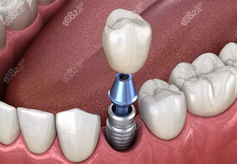 保山市牙科价格公示:牙齿矫正和种植牙需要多少钱都有,牙齿对比照片-8682赴韩整形网