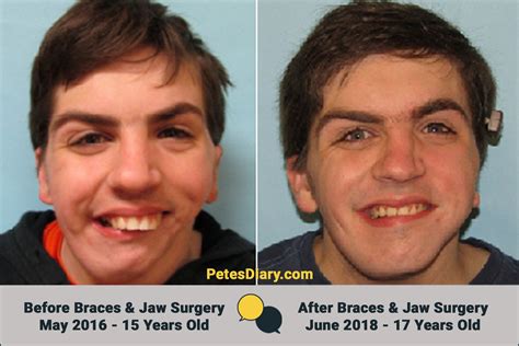 Before & After photos of Peter's jaw reconstruction & braces (Goldenhar Syndrome) | Jaw surgery ...