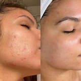 Buy Acne Tea for Pimple Breakouts and Acne Marks
