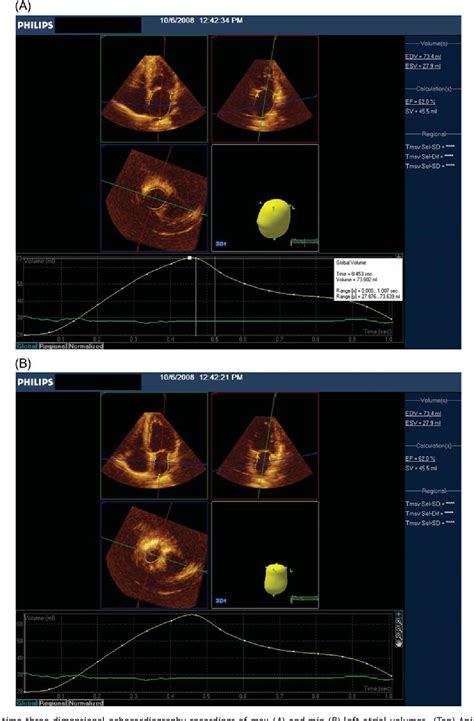 Figure 1 from Normal reference ranges for left and right atrial volume indexes and ejection ...