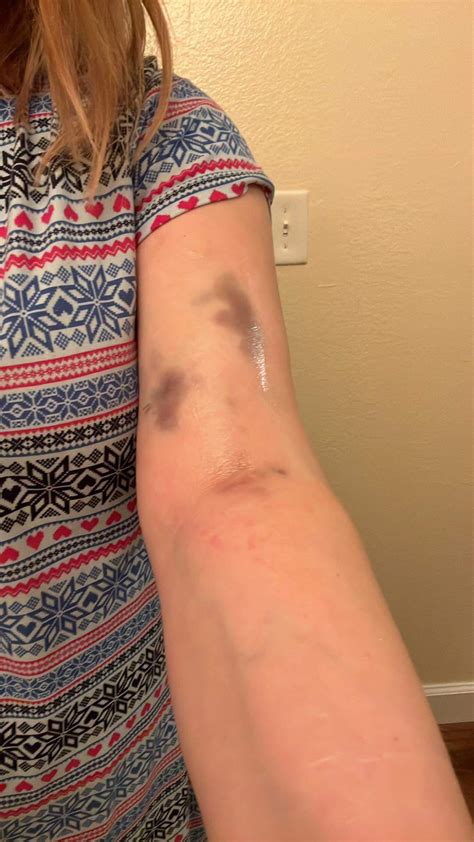 Bruises After Plasma Donation : r/medical
