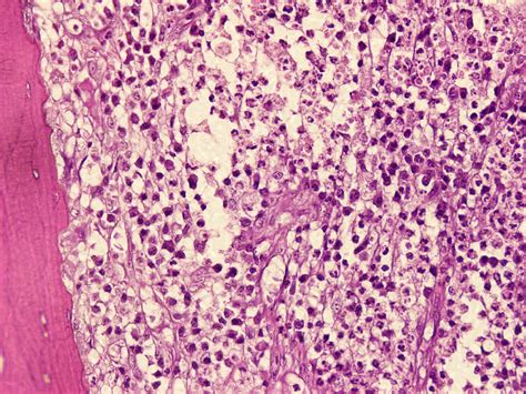 Osteomyelitis Of The Jaw Histology at Johnny Will blog