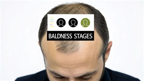 Your Guide to Male Pattern Baldness Stages – My Transformation