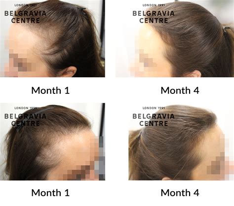 Hair Loss Success Story: "Amazing results after 3 months"