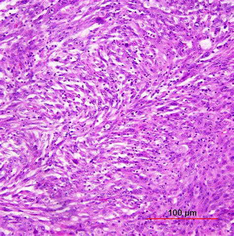 Spindle In Cancer Cells at Clarence Mccarthy blog