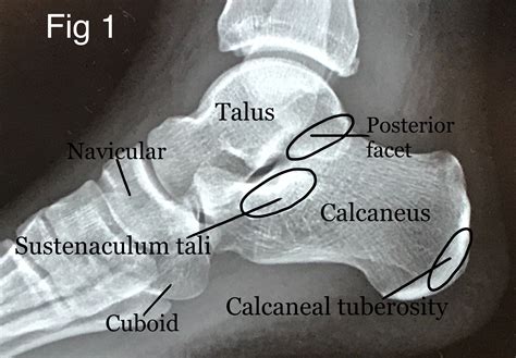 Calcaneus