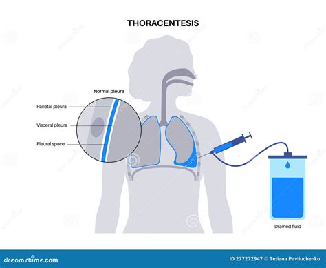 Thoracentesis Procedure Steps