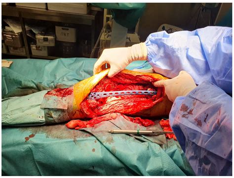 The Use of the Masquelet Technique in the Treatment of Pathological ...