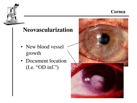 Image result for Slit Lamp Exam Tutorial
