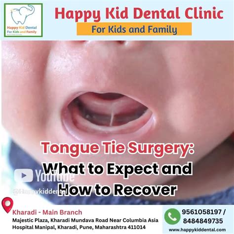 Children Dentist kharadi | Tongue tie surgery, also known as frenotomy or frenectomy, is a ...