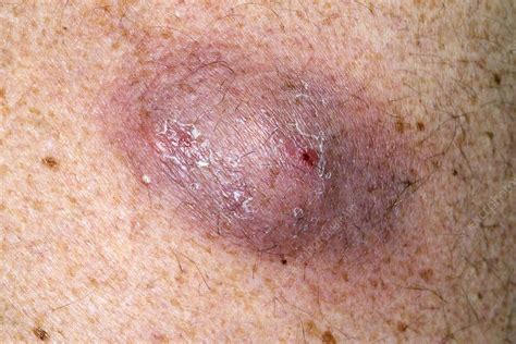Image result for Sebaceous Cyst On Back