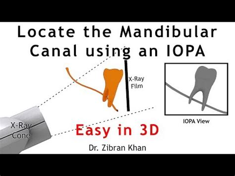 Frank’s Tube Shift Technique
