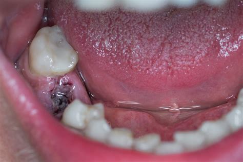 A Dry Socket - What is it, why does it happen, and how is it treated? | Dentist Isle of Man