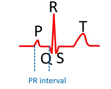 Image result for PR Interval Normal Range