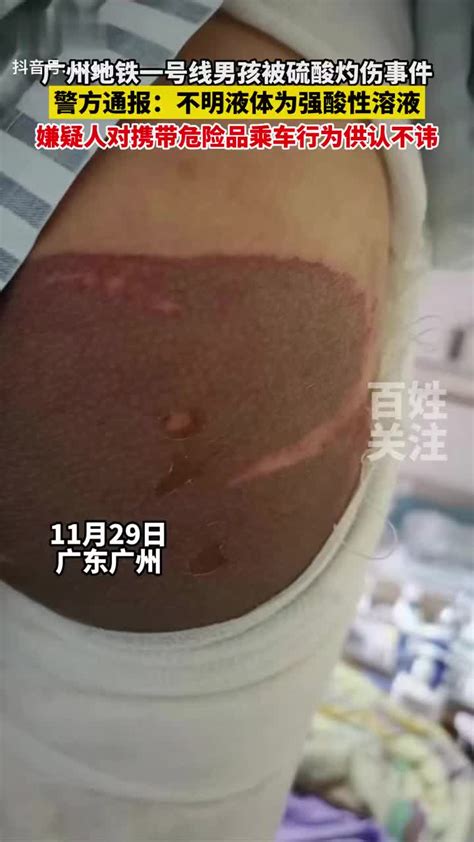 警方通报“广州地铁一号线男孩被硫酸灼伤事件”：系嫌疑人携带强……|嫌疑人_新浪新闻