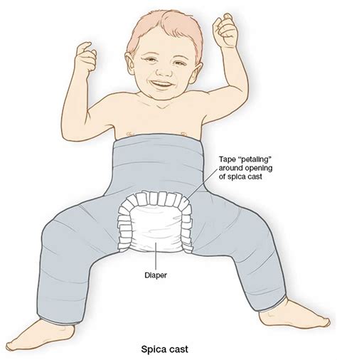 What Is A Spica Cast For at Tyrone Alam blog