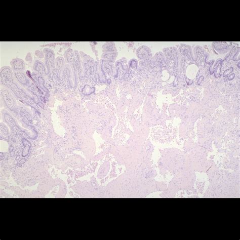 Blue Rubber Bleb Nevus Syndrome | Pediatric Radiology Reference Article ...