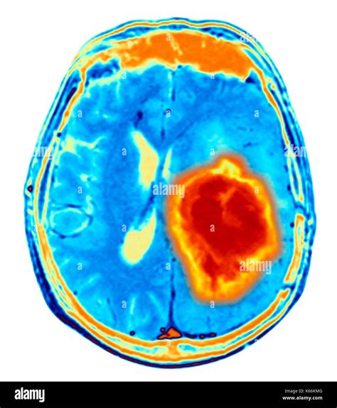 Brain Tumor Color Mri
