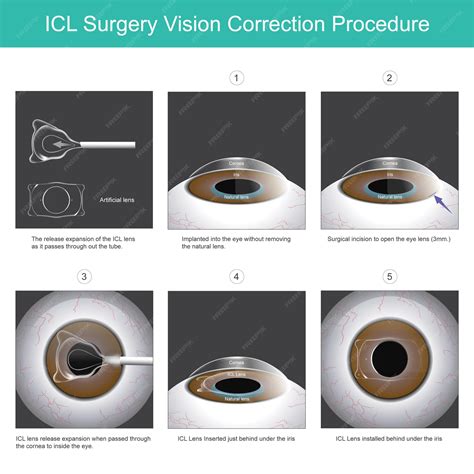 Premium Vector | Icl surgery vision correction procedure a new eye lens that can be implanted