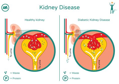 Does Diabetes Affect The Kidneys