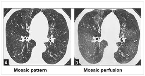 Commonly encountered chest/lung CT scan signs and their relevance