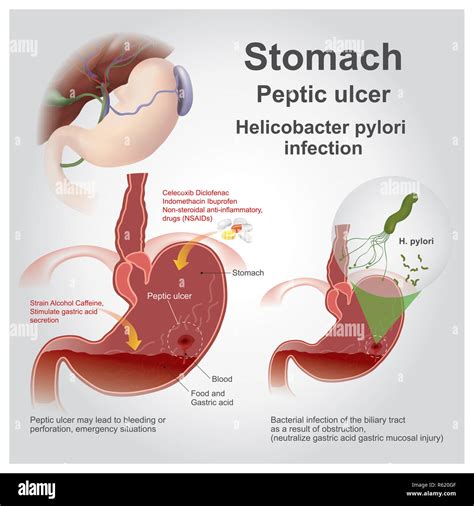 Gastric ulcer bleed hi-res stock photography and images - Alamy