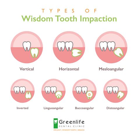 Wisdom Teeth Function 的图像结果