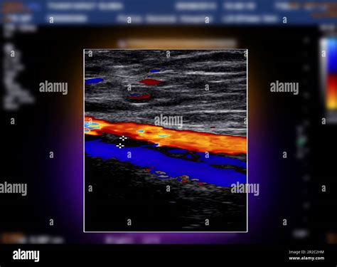A carotid artery Doppler ultrasound is a diagnostic test used to check ...