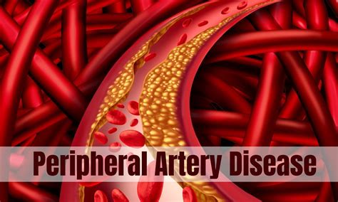Higher serum uric acid linked to peripheral artery disease in male ...