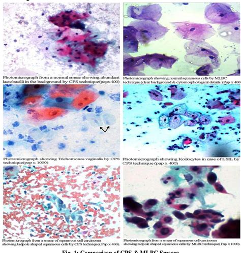 What Is A Cytology Smear at Emily Armytage blog