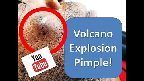 Image result for Worst Exploding Pimple