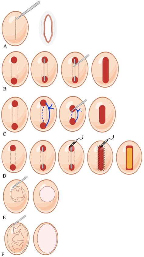 Surgical Approach to Hidradenitis Suppurativa | Actas Dermo-Sifiliográficas