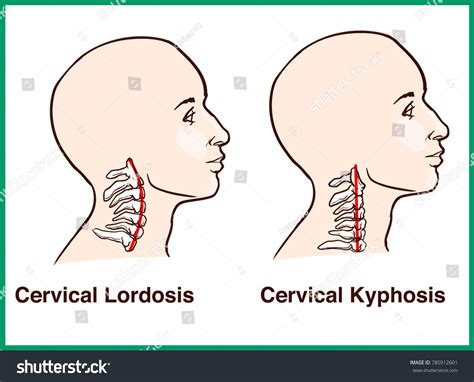 Normal Vs Reversal Cervical Lordosis: vetor stock (livre de direitos) 780912601 | Shutterstock