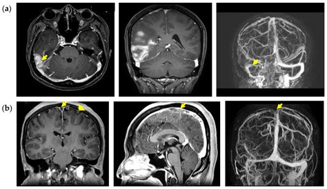 Clinical Characteristics and Prognostic Factors of Non-Infectious Cerebral Venous Sinus Thrombosis
