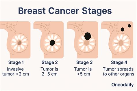 Breast Cancer: Symptoms Causes, Stages, Diagnosis and Treatment - OncoDaily