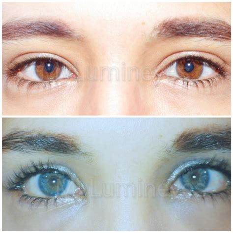 Eye Color Change Surgery Costs with Lasers: Permanent