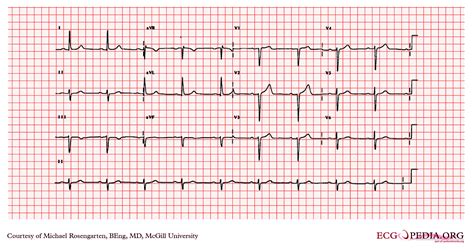 First Degree Av Block Summary Of Heart Blocks 1st Degree Heart Block: